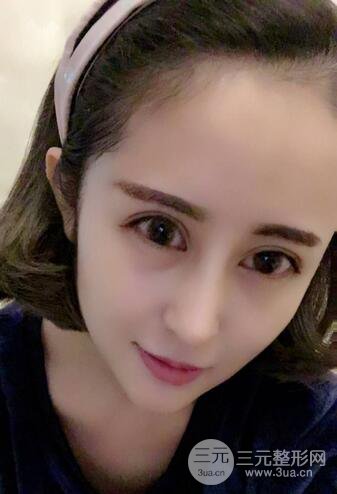 硅膠隆鼻術(shù)前術(shù)后對(duì)比照片分享，走上顏值頂峰