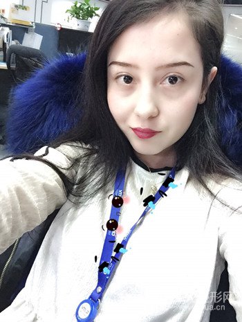 廣州內(nèi)切去眼袋術(shù)后恢復(fù)過程案例對比分享