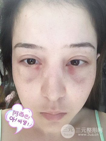 廣州內(nèi)切去眼袋術(shù)后恢復(fù)過程案例對比分享