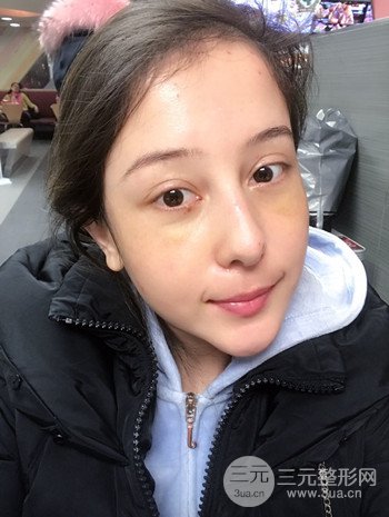 廣州內(nèi)切去眼袋術(shù)后恢復(fù)過程案例對比分享