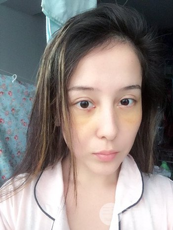 廣州內(nèi)切去眼袋術(shù)后恢復(fù)過程案例對比分享