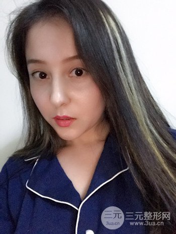 廣州內(nèi)切去眼袋術(shù)后恢復(fù)過程案例對比分享