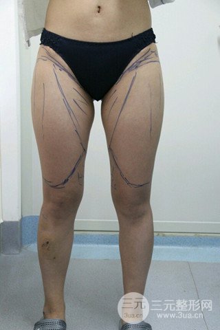 大腿抽脂果好到不行、瘦十厘米不是問題