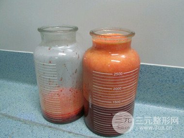 大腿抽脂果好到不行、瘦十厘米不是問題