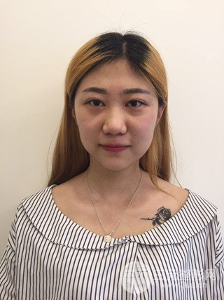 深圳臻希美詳細(xì)部自體脂肪填充果對(duì)比超明X