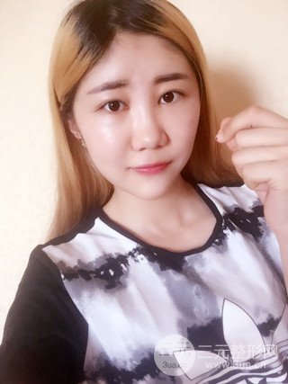 深圳臻希美詳細(xì)部自體脂肪填充果對(duì)比超明X