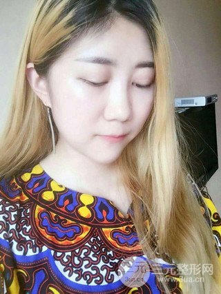 深圳臻希美詳細(xì)部自體脂肪填充果對(duì)比超明X