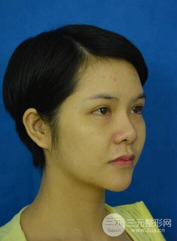 做了隆鼻整形隆鼻之后，短發(fā)女孩也可以性感！