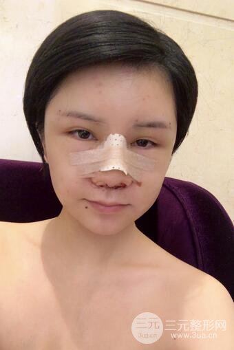 做了隆鼻整形隆鼻之后，短發(fā)女孩也可以性感！