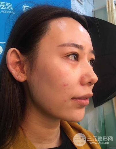 全臉自體脂肪填充，填充不飽滿還可以瘦臉_真人案例