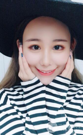 全臉自體脂肪填充，填充不飽滿還可以瘦臉_真人案例