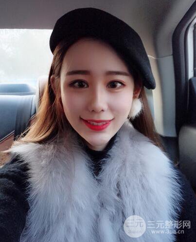 全臉自體脂肪填充，填充不飽滿還可以瘦臉_真人案例