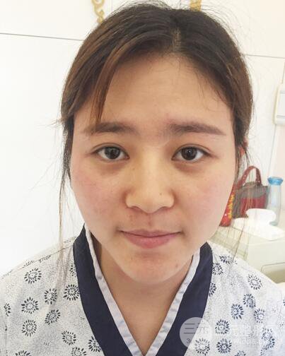 膨體隆鼻術(shù)后恢復(fù)果圖_全過程解密