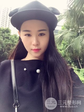 深圳全切雙眼皮修復(fù)成功案例恢復(fù)過程分享