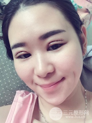 深圳全切雙眼皮修復(fù)成功案例恢復(fù)過程分享