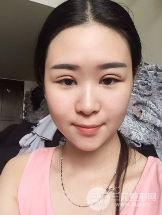 深圳全切雙眼皮修復(fù)成功案例恢復(fù)過程分享