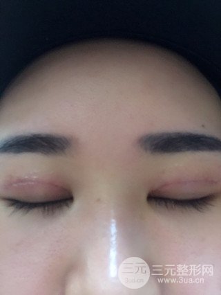 深圳全切雙眼皮修復(fù)成功案例恢復(fù)過程分享