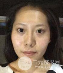 顴骨磨骨改臉型過(guò)程和恢復(fù)步驟照片（圖）