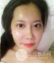 顴骨磨骨改臉型過(guò)程和恢復(fù)步驟照片（圖）