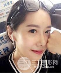 顴骨磨骨改臉型過(guò)程和恢復(fù)步驟照片（圖）