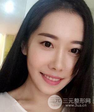 顴骨磨骨改臉型過(guò)程和恢復(fù)步驟照片（圖）