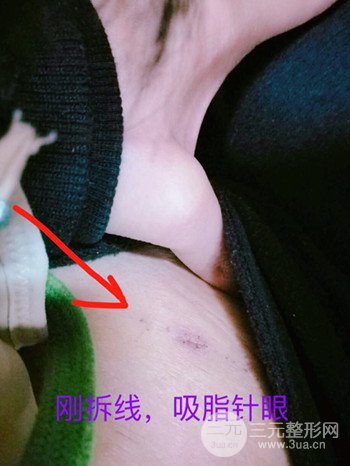 濟(jì)南腰腹吸脂案例三個(gè)月前后變化圖片分享