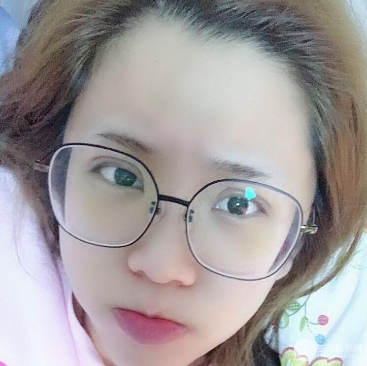 無(wú)錫菲尚徐火旺雙眼皮案例