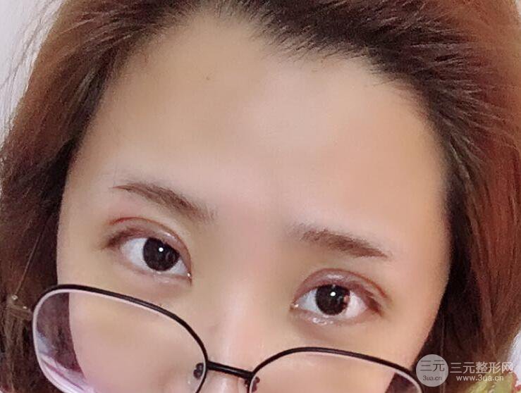 無(wú)錫菲尚徐火旺雙眼皮案例