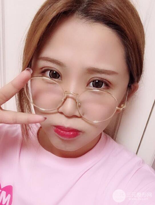 無(wú)錫菲尚徐火旺雙眼皮案例