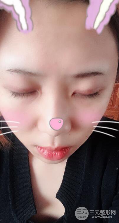 無(wú)錫菲尚徐火旺雙眼皮案例