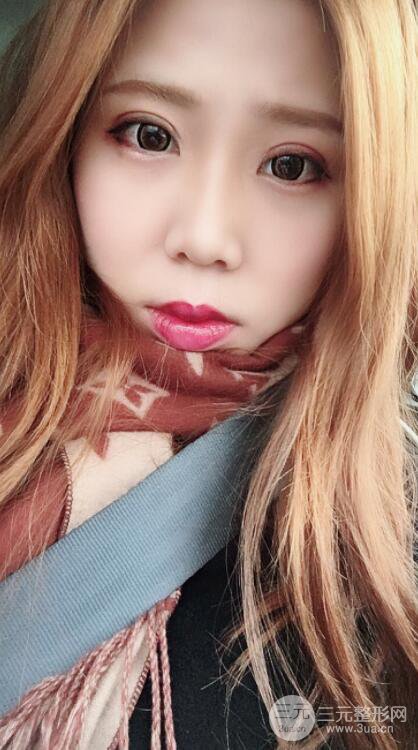 無(wú)錫菲尚徐火旺雙眼皮案例