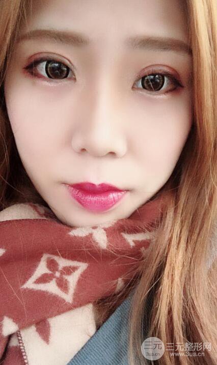 無(wú)錫菲尚徐火旺雙眼皮案例