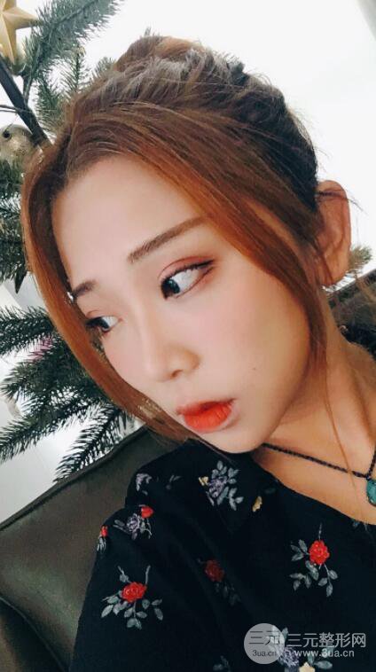 無(wú)錫菲尚徐火旺雙眼皮案例