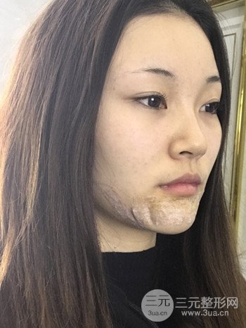 濟(jì)南硅膠假體墊下巴真人案例、下巴改變整個(gè)臉型