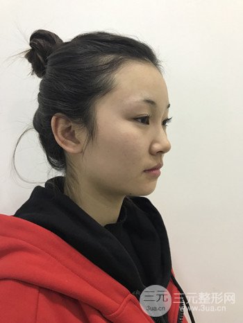 濟(jì)南硅膠假體墊下巴真人案例、下巴改變整個(gè)臉型