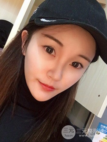 濟(jì)南硅膠假體墊下巴真人案例、下巴改變整個(gè)臉型