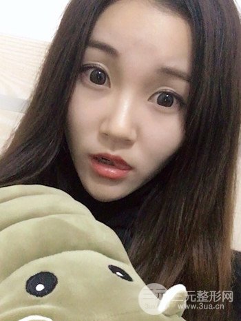 濟(jì)南硅膠假體墊下巴真人案例、下巴改變整個(gè)臉型