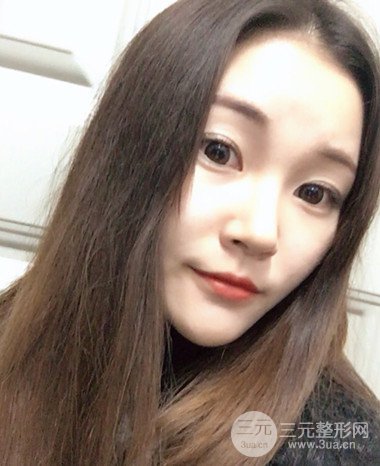 濟(jì)南硅膠假體墊下巴真人案例、下巴改變整個(gè)臉型