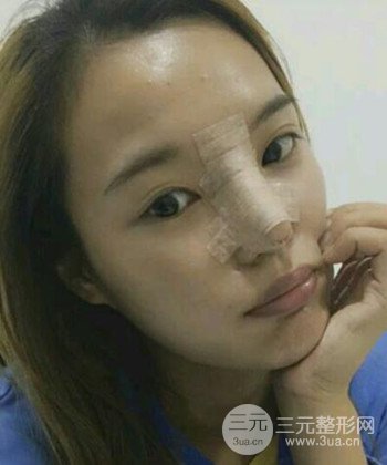 模特做隆鼻整形真實日記分享，附上恢復過程圖