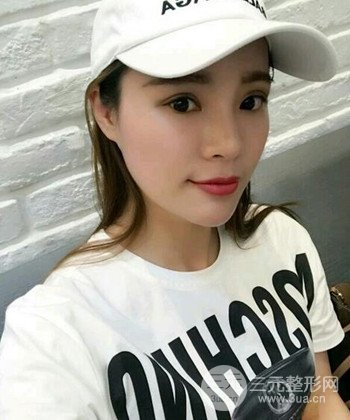 模特做隆鼻整形真實日記分享，附上恢復過程圖