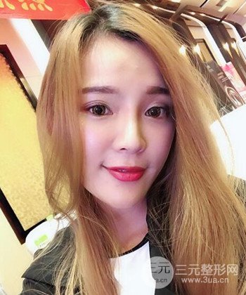 模特做隆鼻整形真實日記分享，附上恢復過程圖