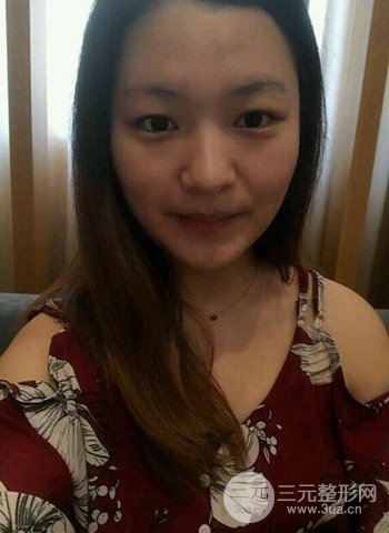 深圳雙眼皮正就內雙小眼睛，真實案例前后對比照片