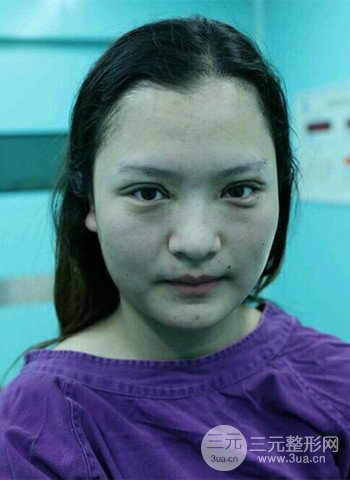 深圳雙眼皮正就內雙小眼睛，真實案例前后對比照片