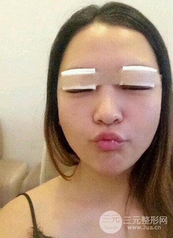 深圳雙眼皮正就內雙小眼睛，真實案例前后對比照片