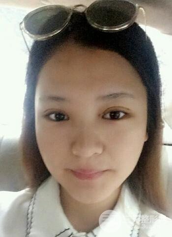 深圳雙眼皮正就內雙小眼睛，真實案例前后對比照片