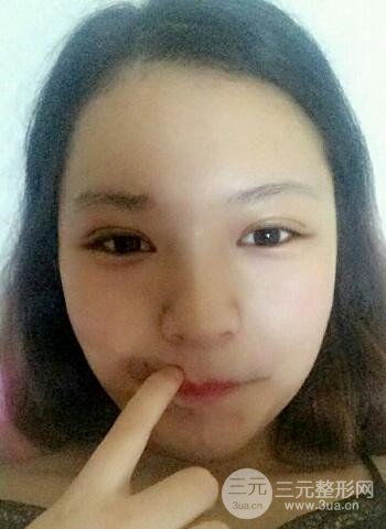 深圳雙眼皮正就內雙小眼睛，真實案例前后對比照片