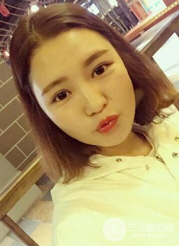 深圳雙眼皮正就內雙小眼睛，真實案例前后對比照片