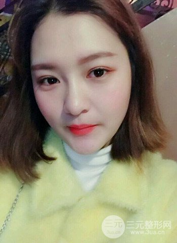 深圳雙眼皮正就內雙小眼睛，真實案例前后對比照片