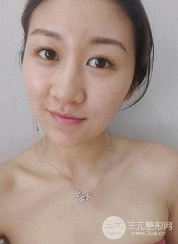 廣州隆鼻整形真實恢復期圖片，擁有精致美鼻不是夢