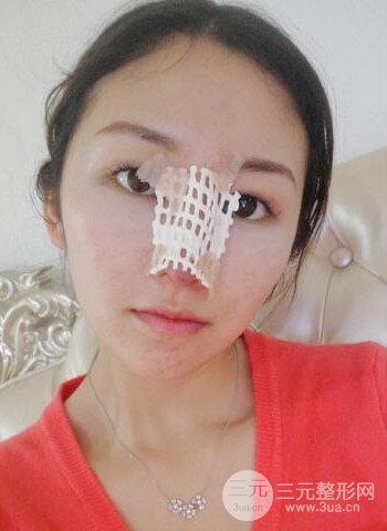 廣州隆鼻整形真實恢復期圖片，擁有精致美鼻不是夢